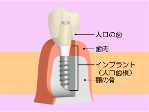 歯科用インプラント