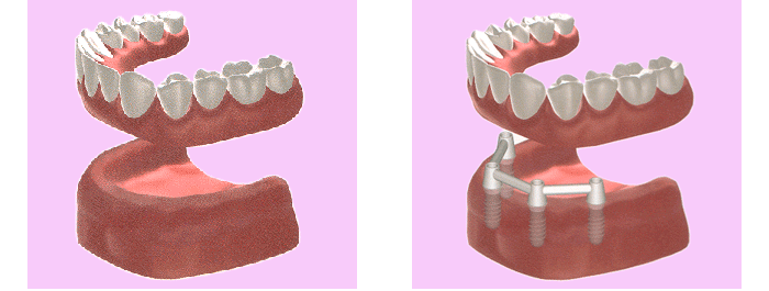 歯が全てない場合は、固定式のデンチャーを用いて固定