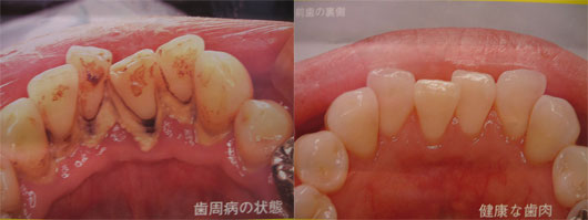 歯周病の口内と健康な口内
