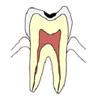 エナメル質の虫歯