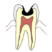 象牙質まで達した虫歯