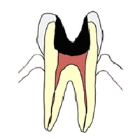 歯髄（神経）まで達した虫歯