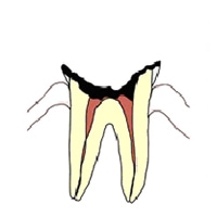 歯根しか残っていない虫歯