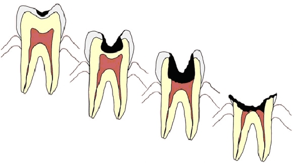 虫歯の進行段階